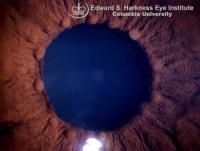 Multiple koeppe's nodules lie at the pupillary margin.